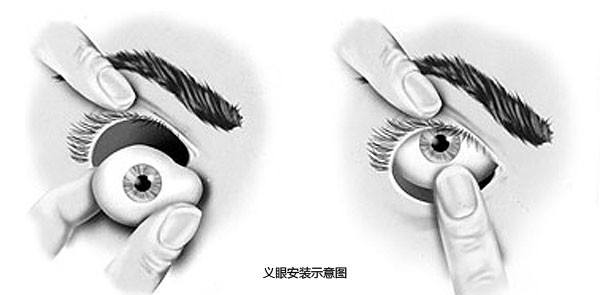 真假難辨，義眼移植術帶你重拾自信