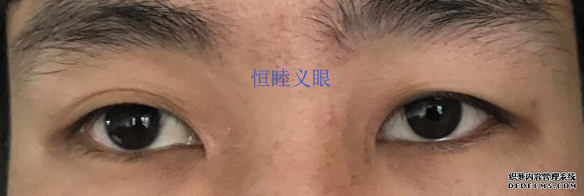 林先生佩戴更換義眼片，保留眼球，眼球萎縮