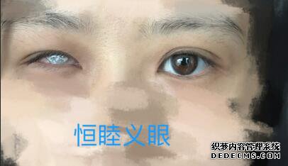 眼球萎縮，第一次佩戴義眼片